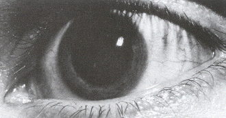 Enlarged pupil (an eye with iritis)