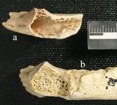 Neanderthal-bone-tumor_68206_200x150