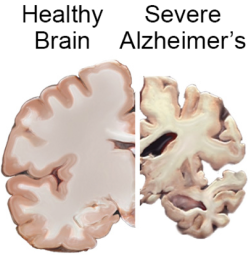 Alzheimers-brain