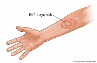 Bulls eye rash