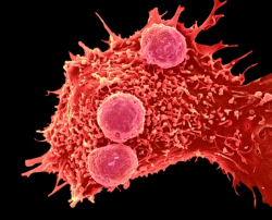 WEB_C0288799-Cancer_cell_and_T_lymphocytes,_SEM-SPL