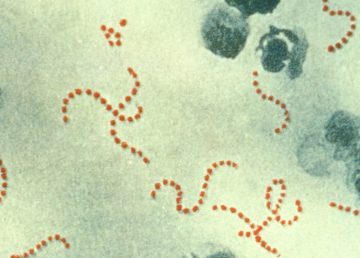 Streptococcus pyogenes (red-stained spheres) is responsible for most cases of severe puerperal fever. It is commonly found in the throat and nasopharynx of otherwise healthy carriers.