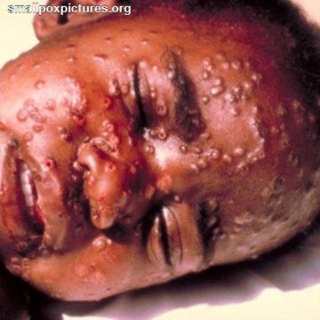 Child with lesions of smallpox on faces and likely all over the body.