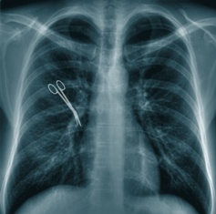 Scissors on Chest X-Ray